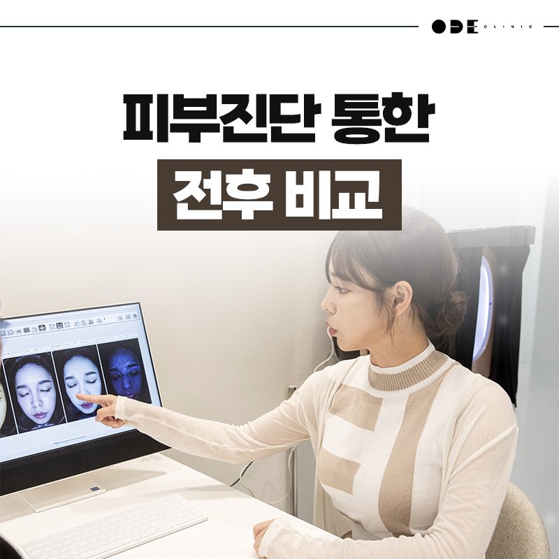 Ultherapy Prime lifting Seoul